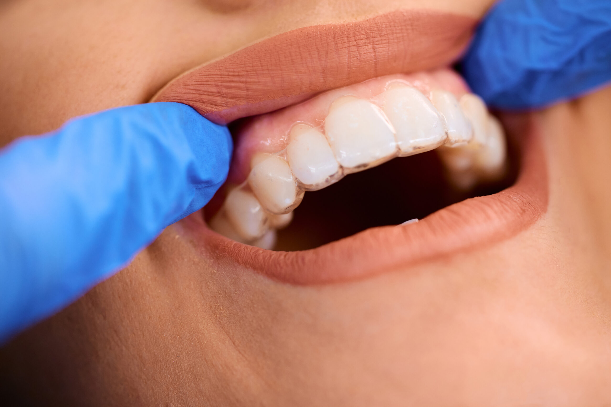 Close up of woman getting Invisalign on her teeth at dentist's