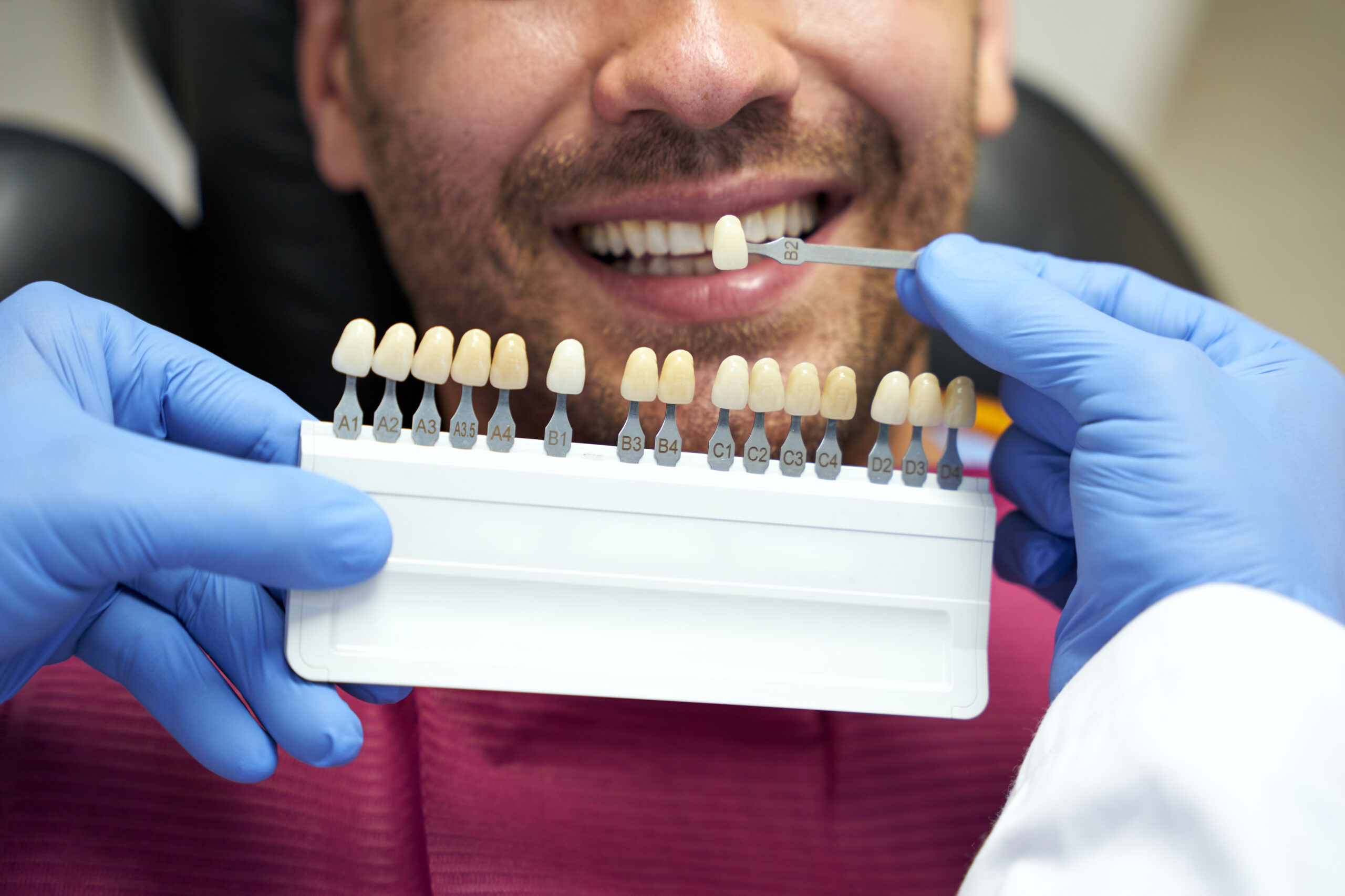 Bearded man smiles while dentist picks proper shade of veneers