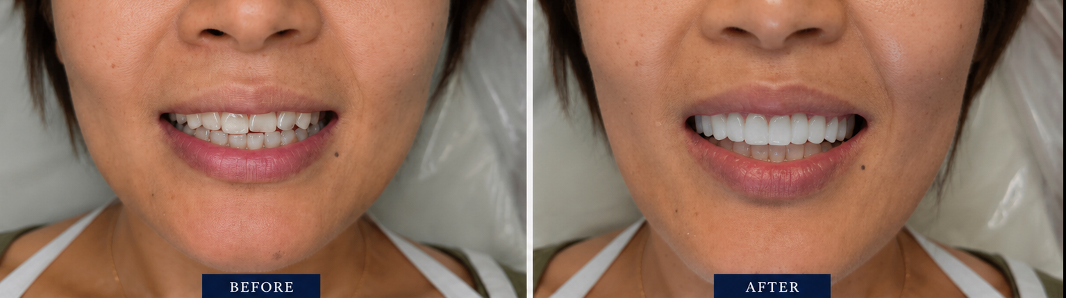 Before and After smile transformation 3