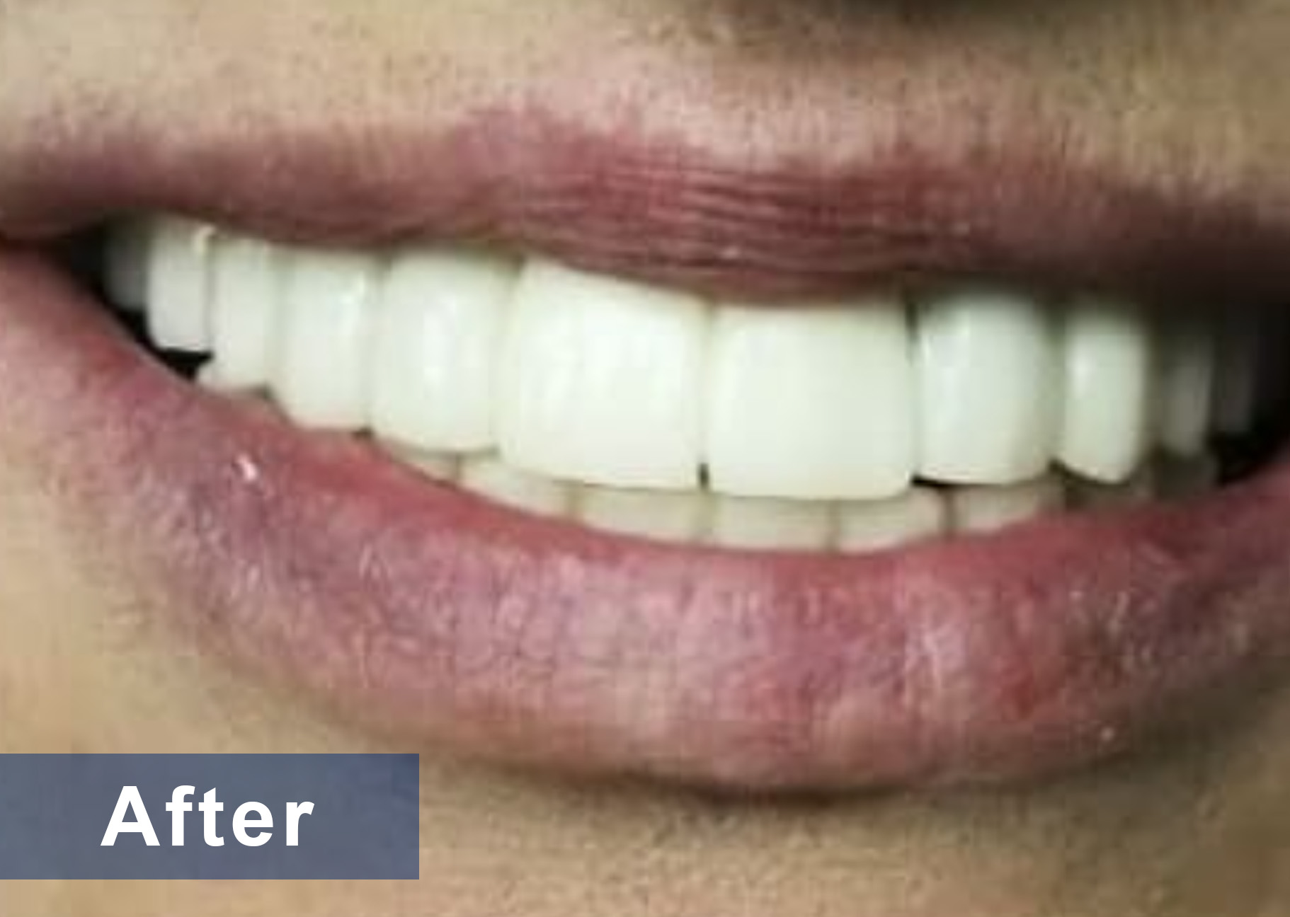 After full mouth reconstruction