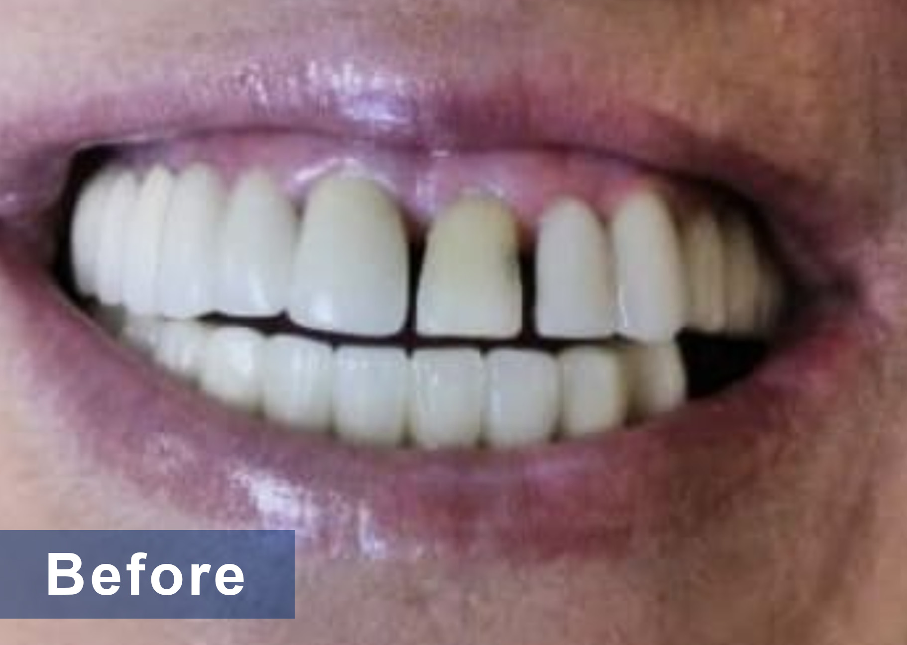 Before full mouth reconstruction